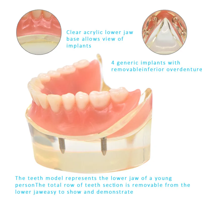 Зубные протезы, модель зубов, съемные внутренние нижние челюсти, модель нижних зубов с имплантатом для обучения зубов