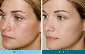 GLYCOLIC ACID BEFORE & AFTER