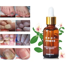 30 мл лечение проблем ногтей ремонт оонихомикоза Уход за ногтями рингчервь ногтей leuconychia эфирное масло регенерации гель