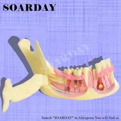 Нижняя челюсть патологическая модель стоматологические кариес коммуникационная Модель Смола Материал нерв дисплей
