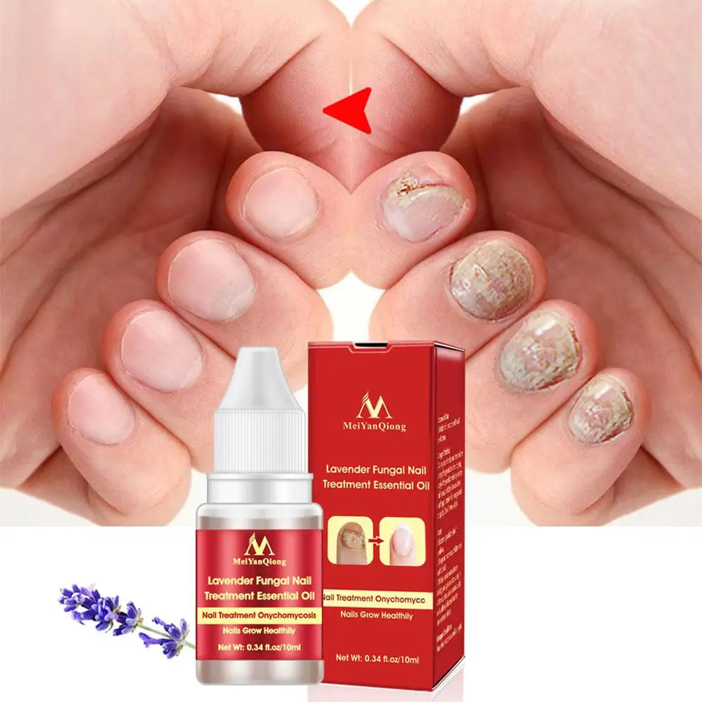 

BellyLady Lavender Fungal Nail Treatment Nail Protector Essential Oil HerbTreatment Infection Paronychia Essential Oil