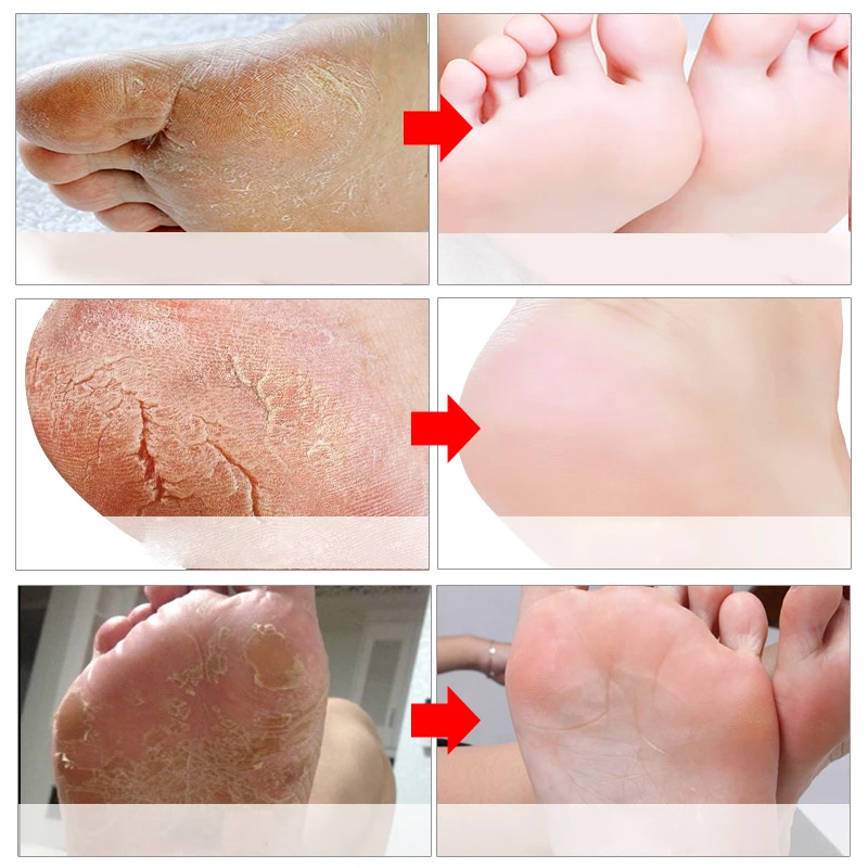 EFERO 3Pair=6PCS Peeling Foot Mask Exfoliating Scrub