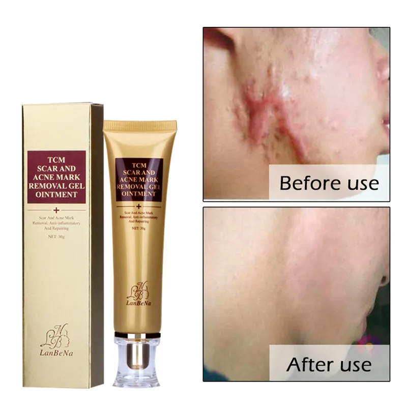 2018-Hot-Sale-PRO-Acne-Scar-Removal-Cream-Strentch-Marks-Acne-Scar-Remover-Acne-Treatment-Shrink