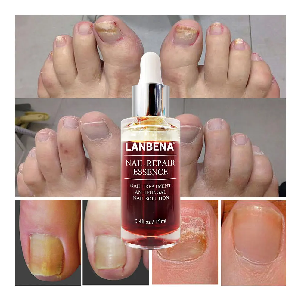 LANBENA средство для восстановления ногтей, сыворотка, лечение грибков, удаление онихомикоза, ноготь, питательное осветление, уход за руками и ногами