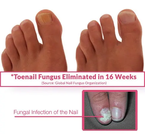 Nail-Fungus-Eliminated-in-16-Weeks-Graphic2
