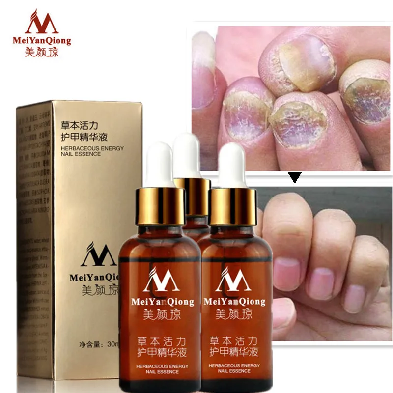 

3pcs Fungal Nail Treatment Essence Foot Whitening Toe Fungus Removal Feet Essential Oil