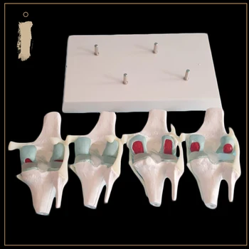 

Pathological knee joint model knee joint degenerative knee arthroscopy arthroscopic surgery education model