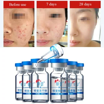 

1pc Freeze-dried Powder Scrum Solvent Essence Acne Elimination Acne Pit Acne Red Blood Silk Repair Facial Skin Essence