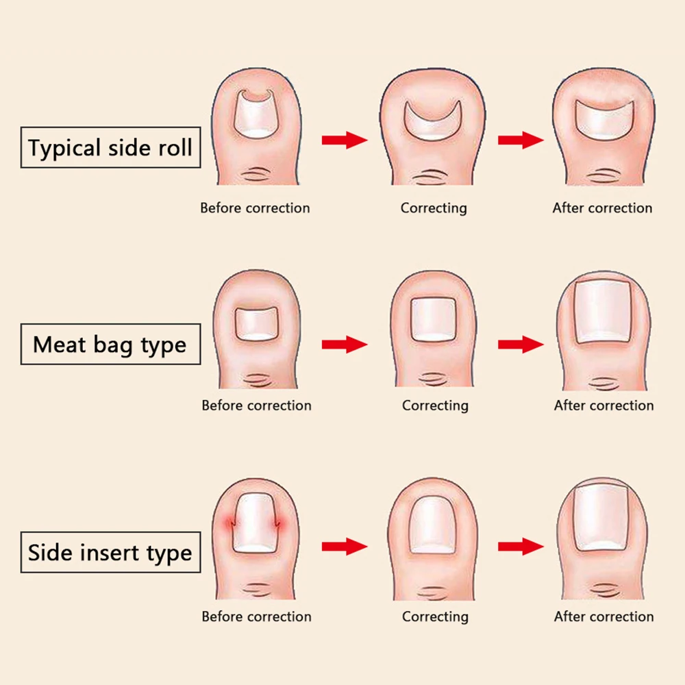 Аксессуары для обуви, коррекция, облегчение боли, регулятор ногтей, регулировка ногтей, инструменты для вросшего педикюра, инструмент для восстановления