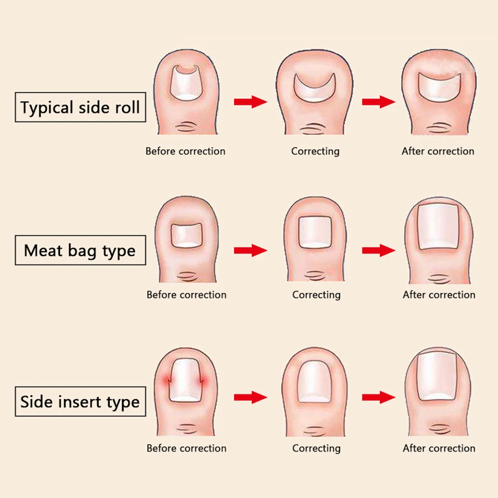 Аксессуары для обуви коррекция боли ногтей регулировка инструменты вросших
