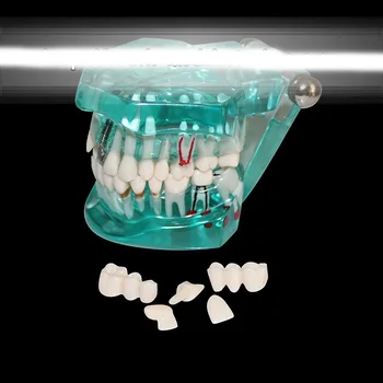 

Dental pathology model Dental caries dental plaque planting tooth model Dental Implant teaching Model