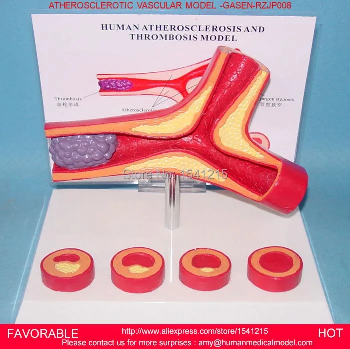 

HEMATOLOGY VESSEL MODEL ATHEROSCLEROSIS MODEL HUMAN OFFSHOOT ATHEROSCLEROTIC VASCULAR MODEL, VASCULAR MODEL-GASEN-RZJP008