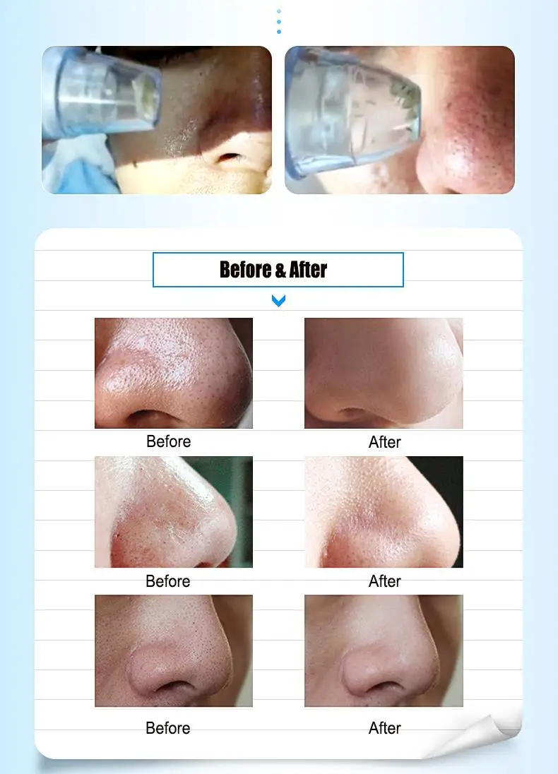 Y.F.M<ALIMT >®</ALIMT> Rechargeable Electric Blackhead Suction Acne Remover Vacuum Microdermabrasion Pore Cleanser Facial Skin
