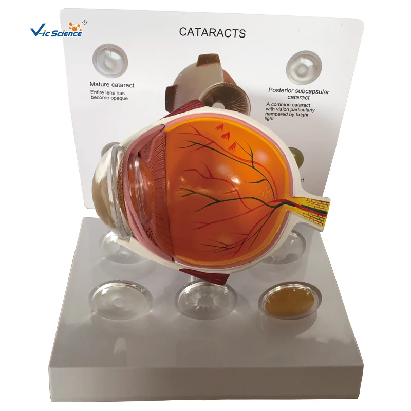 

Medical Education Advance Cataract Eye Model Anatomy Model