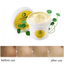 Cream For Stretch Marks And Scar Removal Powerful To Stretch Marks Maternity Skin Body Repair Cream Remove Scar Care Postpartum