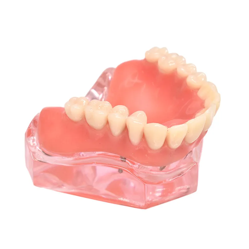 Dental Overdenture Teeth Model Removable Interior Mandibular Lower Teeth Model Mandibular with Implant for Tooth Teaching Study Dental Overdenture Teeth Model Removable Interior Mandibular Lower Teeth Model Mandibular with Implant for Tooth Teaching Study