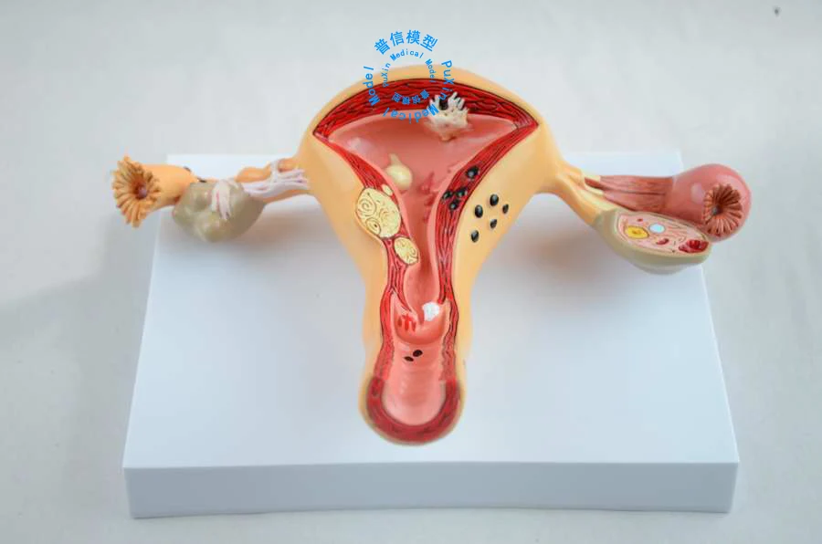 Freies Verschiffen Die Pathologischen Modell Der Gebarmutter Gebarmutter Anatomie Genital Orgel Dissect Modell Lehre Fur Medizinische For Medical Genital Organsuterus Model Aliexpress