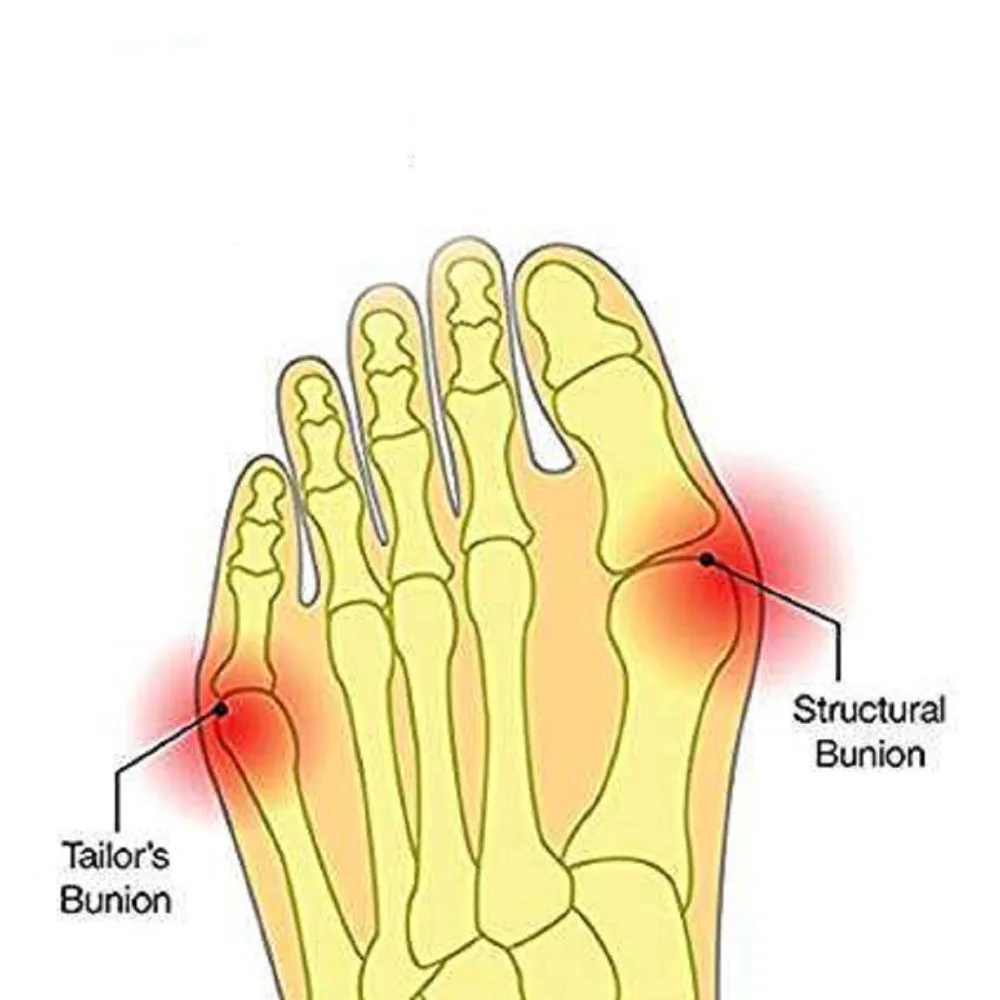 2 шт. корректор Bunion и Relief диабетический Уход за ногами антимозольные прокладки