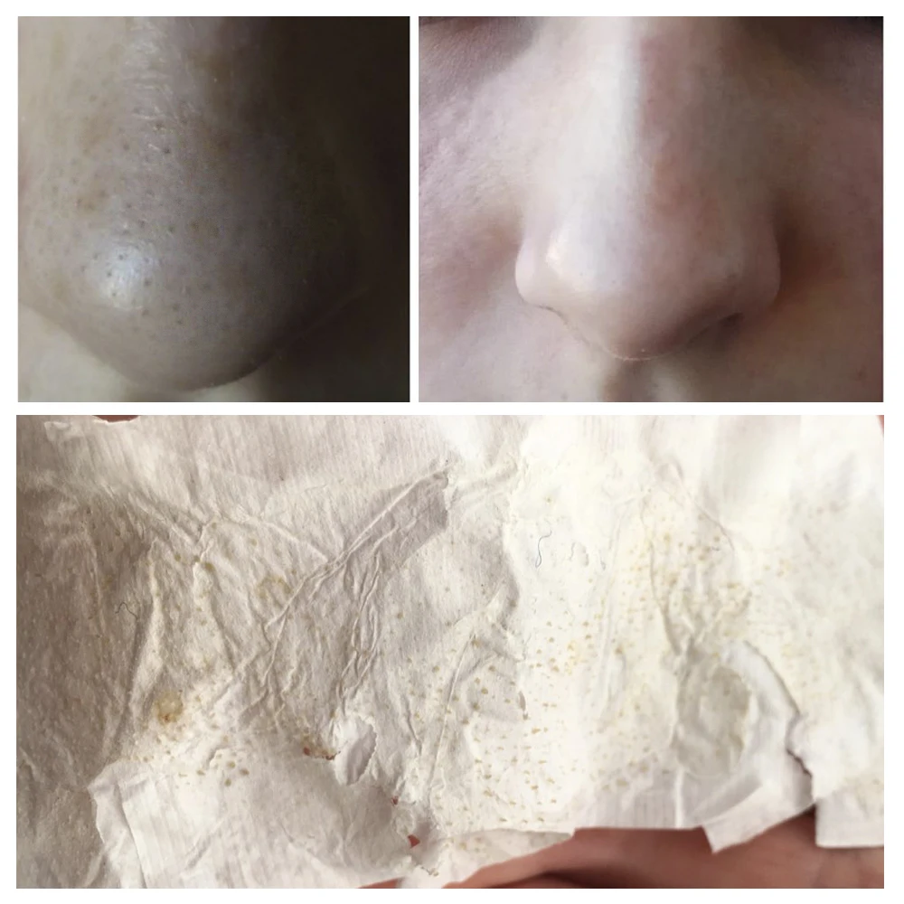 

LANBENA Blackhead Remover Nose Mask Deep Cleansing Skin Care Pore Strip Black Mask Peeling Acne Treatment Skin Care TSLM2