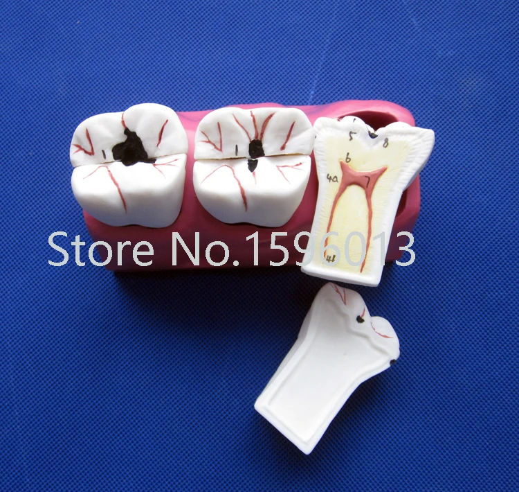 

Dissected Model of Dental Caries,Caries decomposition model