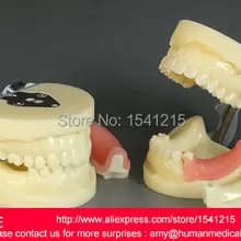 Анатомическая обучение устной протезы зубные, взрослые зубные Зубы Модель, рот уход за полостью рта MODEL-GASEN-DEN015