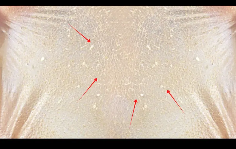 rose-blackhead-removal_09