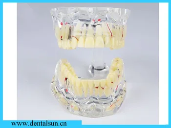 

Dental Supply pathological model/Dental model of standard adult /Tooth model for implant