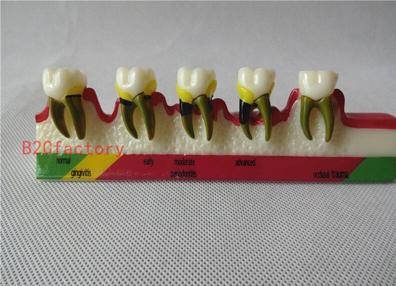 

Dental Teeth Model Periodontal Disease Assort Tooth Classification Model 1pc