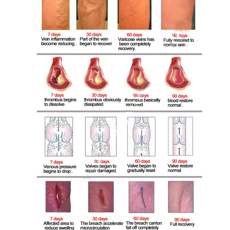2/3/4/5/10 шт. расширения вен медицинский препарат против варикозного расшрения вен лечение крем анти ноги васкулита флебит травяной продукт dropshoping