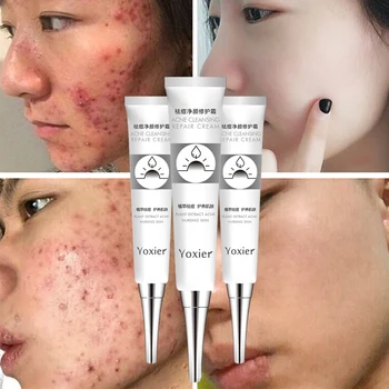 

Face Acne Cleaning Cream Skin Care Remove Repair Pimple Acne Quickly Face Acne Cream Remover Anti Acne Treatment