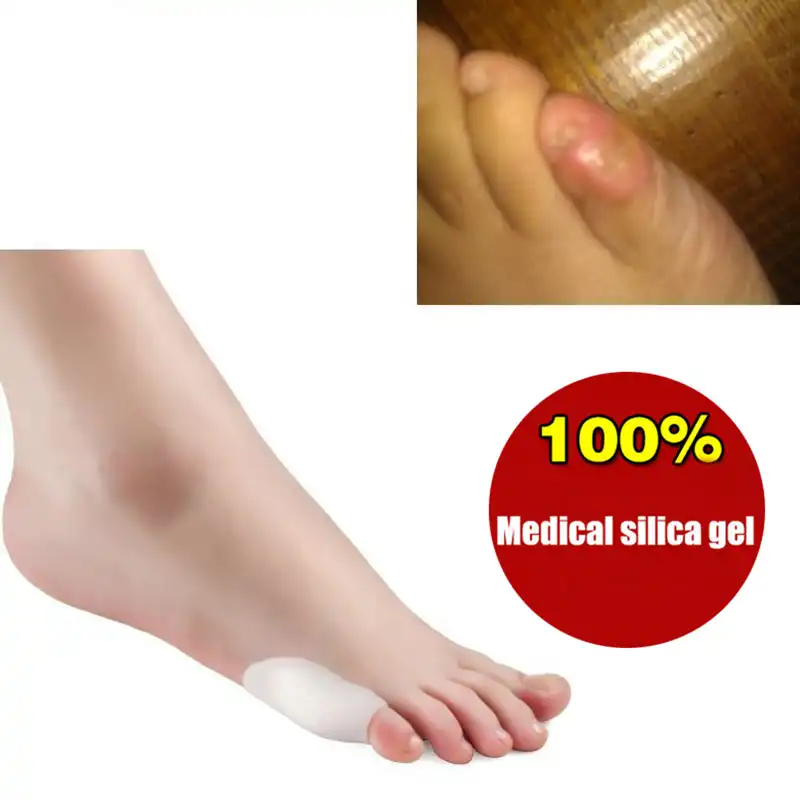juanetes en los pies dedo pequeño juanetes en los pies dedo pequeño