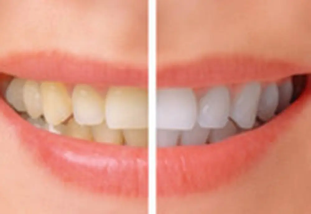 Tongwode зубов набор для отбеливания в домашних условиях вращающийся перекиси водорода гелевая ручка Мощный полировки зубов Красители камеди защищает отбеливание комплект