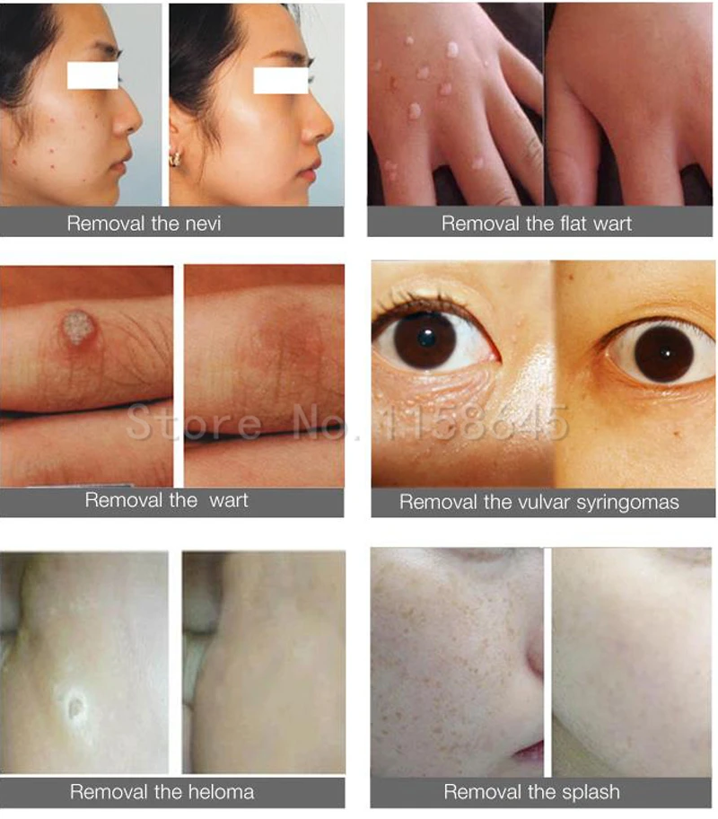 Freckle Spot Removal (7)