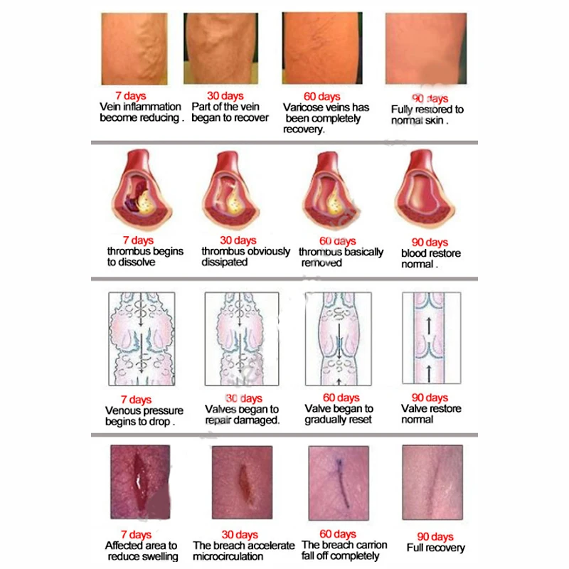 Мазь для варикозных вен Eins лечение Варикозного расширения пластырь для лечения варикозного расширения вен пластырь для лечения васкулита натуральный раствор травяные пластыри
