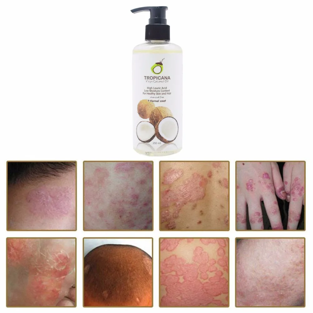 Tropicana Virgilio Olio di Cocco per la Psoriasi Trattamento Efficace per  la Pelle Sana| | - AliExpress
