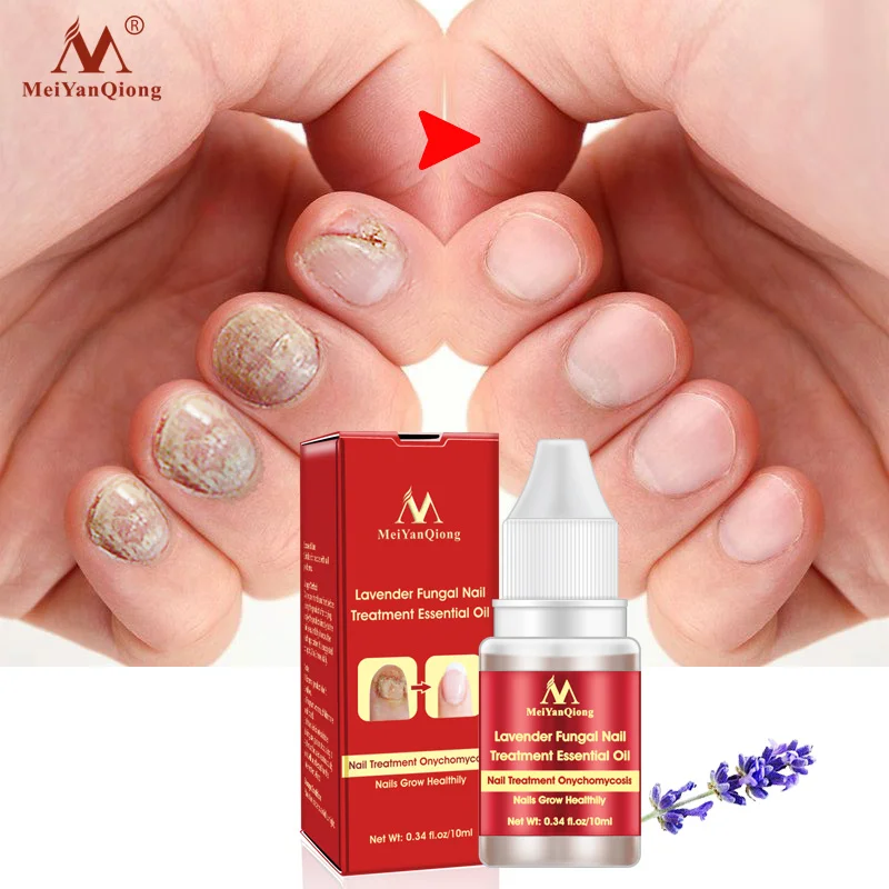 

10ml Nail Fungus Treatment Anti Fungal Toenail Repair Care Lavender Essential Oil MH88