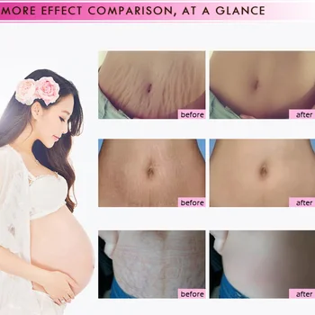 

Stretch Mark Repair Cream Pregnancy Scars Removal Body Skin Care for Pregnant can CSV