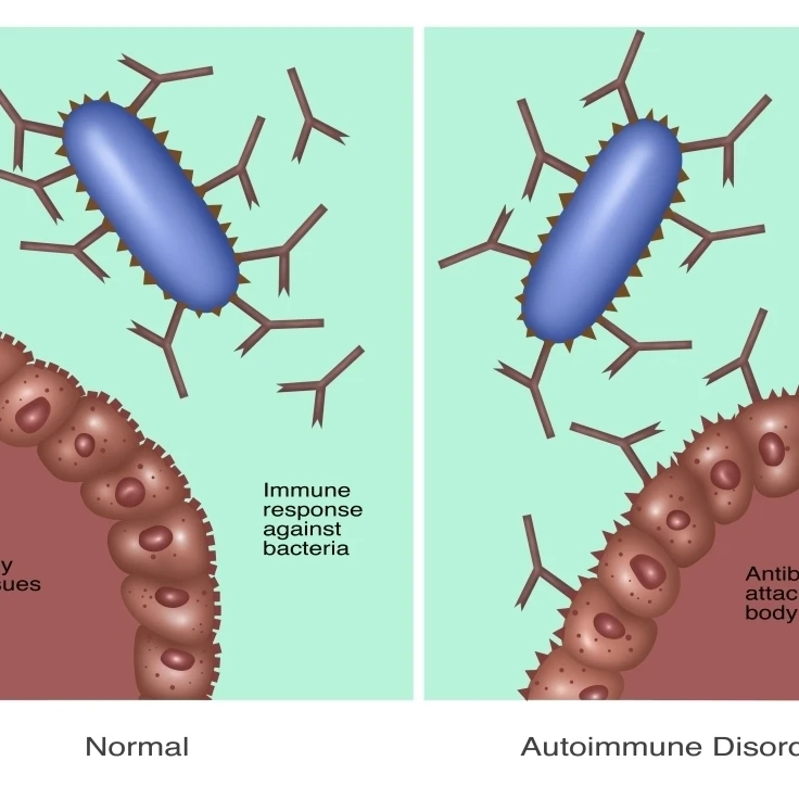 Normal Immune System & Autoimmune Disease Poster Print by Gwen ShockeyScience Source (36 x 24)