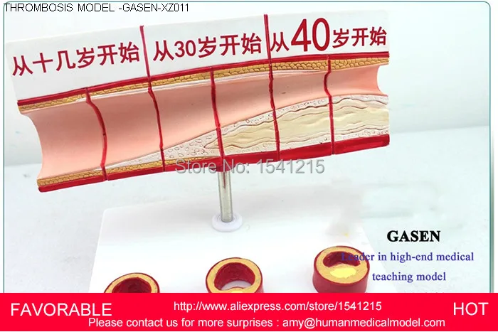 

ANATOMIC HEART MODEL PROCESS MODEL MEDICAL MODEL OF LIPID CHOLESTEROL AGE MODEL CORONARY HEART DISEASE THROMBOSIS -GASEN-XZ011