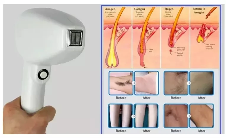 Новый стиль неканальный диодный лазер 808nm диодный лазер удаление волос Германия безболезненный диод