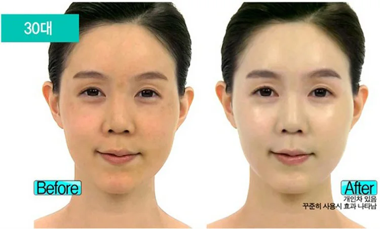 skin bleaching for acne scars