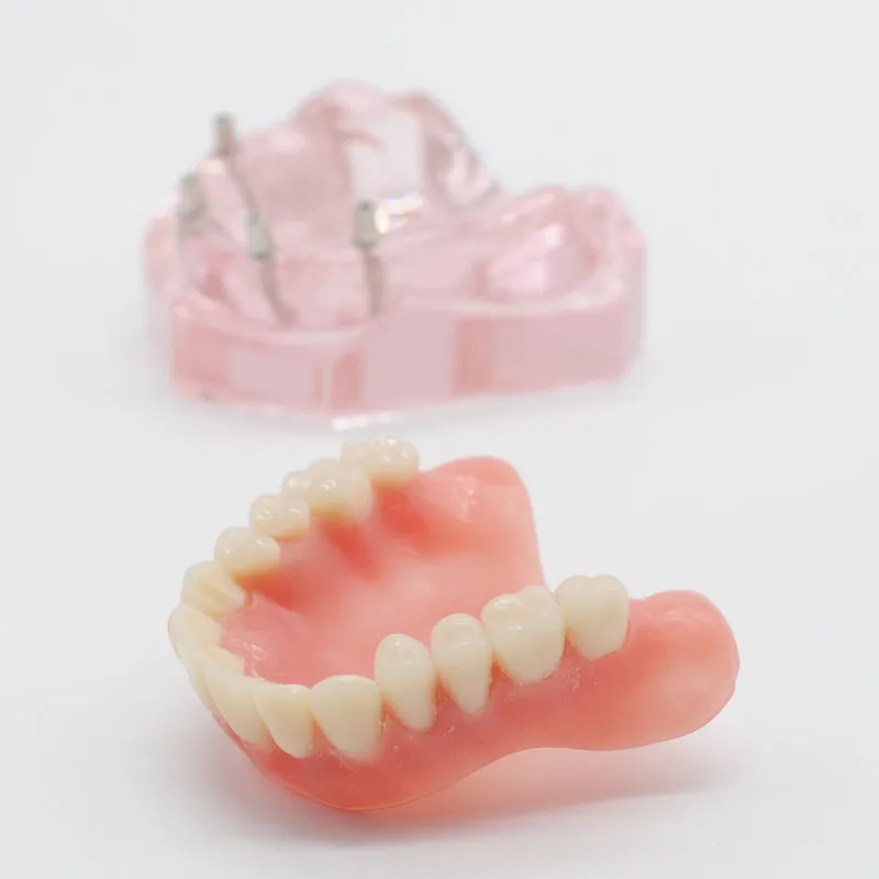 Стоматология Лаборатория Модель исследования зубов Overdenture низший 4 имплантата демонстрационная модель