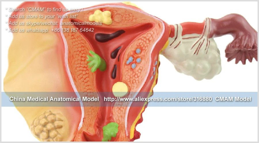 12473 cmam-anatomy35 женский матки яичников заболевания влагалища Спецодежда медицинская модели, Медицинские товары преподавания анатомические