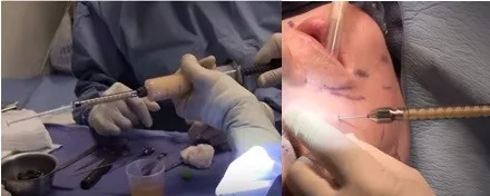 face grafting