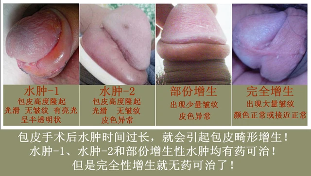 Penis Edema 105