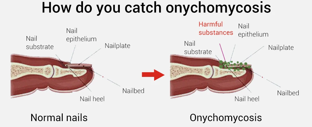 Травяное Лечение ногтей Удаление онихомикоза Paronychia против грибковой инфекции ногтей эффективная рука и уход за ногтями на ногах гель LANBENA