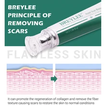 30 г уход за кожей тела акне лечение кожи мазь для лечения шрамов крем для удаления против морщин травяные усадки поры осушение отбеливание чёрных точек