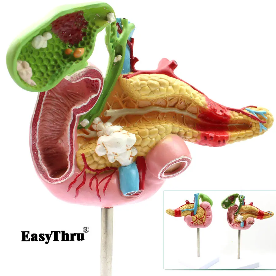 

Medical Pancreatic Duodenal Gallbladder Pathological Model Gallstone Surgery Digestive System Model Medical Science