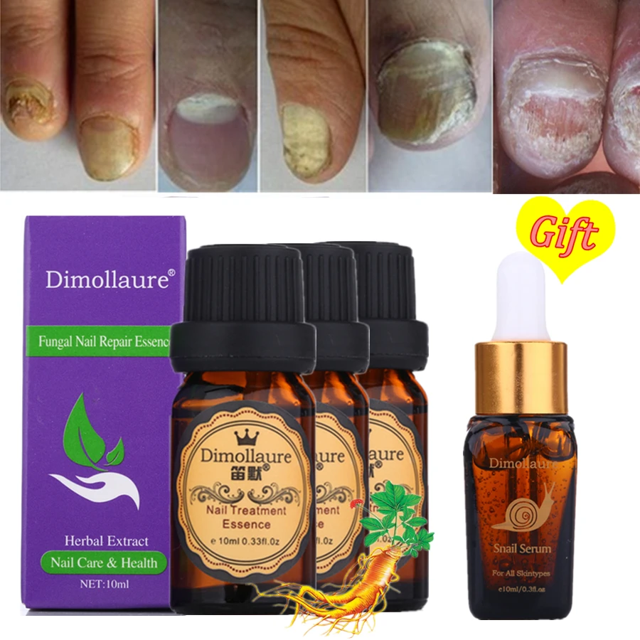 

Buy 3 Get 1 Gift Dimollaure Fungal Nail Treatment Essence Hand Foot Toe Nail Fungus Removal Gel Anti Infection Gel Onychomycosis