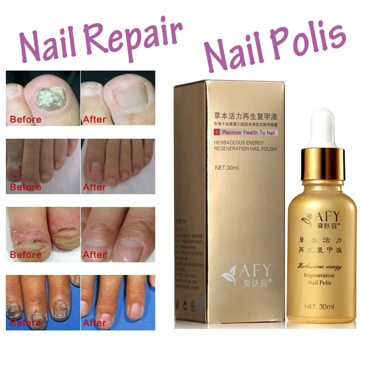 Fungal Nail Treatment Tcm Essence Oil Hand And Foot Whitening Toe Fungal Nail Treatment Tcm Essence Oil Hand And Foot Whitening Toe Fungus Removal Feet Care Polish Tools Gel In Treatments From Beauty